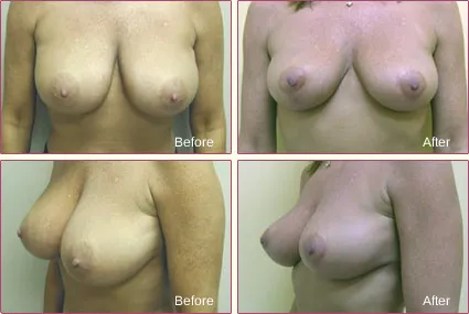 Breast Reduction before and after set 1