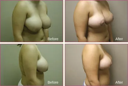 Breast Reduction before and after set 3
