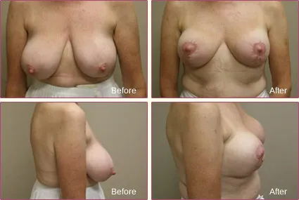 Breast Reduction before and after set 4