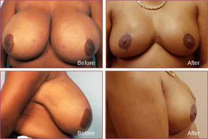 Breast Reduction before and after set 5