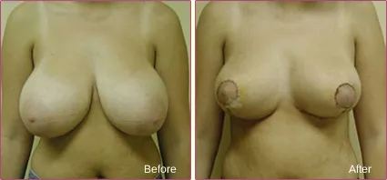 Breast Reduction before and after set 6