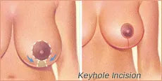 Keyhole Incision