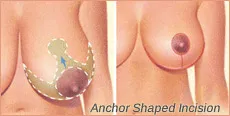 Anchor Shaped Incision