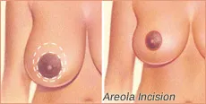 Areola Incision